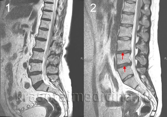 stuburo osteochondrozė